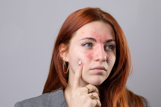 ¿Cómo tratar la rosácea y la piel sensible sin empeorar los síntomas?